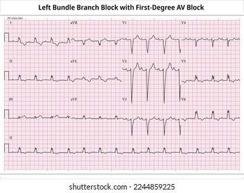 ECG First-Degree AV Block with LBBB (Left Bundle Branch Block) - 12 Leads ECG Paper - Vector - Medical Illustration