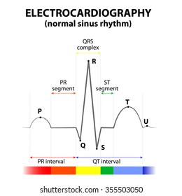 ECG of a heart in normal sinus rhythm. Schematic representation. wave and segment names