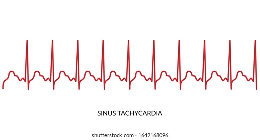 Sinus Tachycardia Images Stock Photos Vectors Shutterstock
