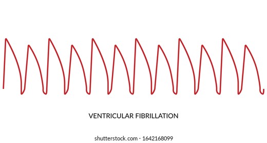 ECG Heartbeat Line. Electrocardiogram vector illustration. Ventricular Fibrillation