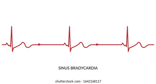 ECG Heartbeat Line. Electrocardiogram vector illustration. Sinus Bradycardia