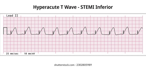 ECG Hyperacute STEMI - 8 Second ECG Paper - Peaked T Wave - Vectors and Illustrations for Medical Purposes