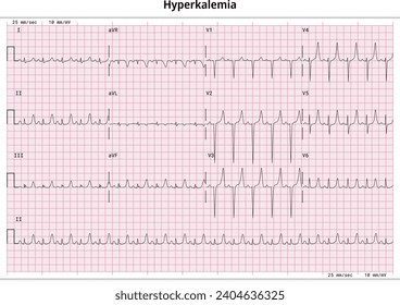 ECG Hyperkalemia - Hyperkalaemia - 12 Lead ECG Common Case - 3 Sec per lead - Vector Medical Illustration