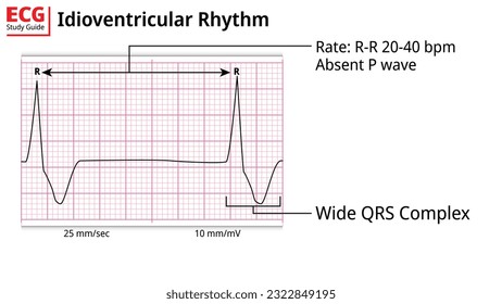 ECG Idioventricular Rhythm - ECG Education with Study Guide - Electrocardiogram Medical Vectors Illustrations