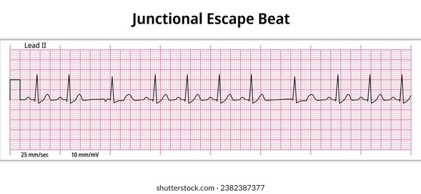 ECG Junctional Escape Beat - 8 Second ECG Paper - Electrocardiogram Vector Medical Illustration