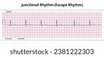 ECG Junctional Rhythm - Escape Rhythm - 8 Second ECG Paper - Electrocardiogram Vector Medical Illustration