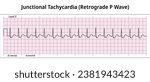 ECG Junctional Tachycardia - Retrograde P Wave - 8 Second ECG Paper - Electrocardiogram Vector Medical Illustration