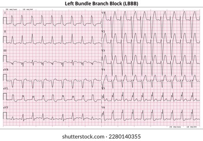 ECG LBBB (Left Bundle Branch Block) - 12 Lead ECG Common Case - 6 Sec - Vector Illustration