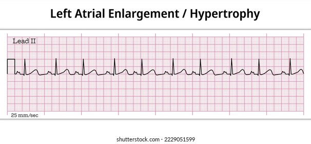 ECG Left Atrial Enlargement - 8 Second ECG Paper - Left Atrial Hypertrophy svg