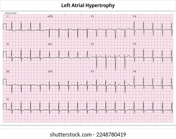 ECG Left Atrial Hypertrophy - Left Atrial Enlargement - 12 Leads ECG Paper - Vector - Medical Illustration svg