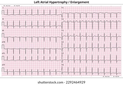 ECG Left Atrial Hypertrophy (LVH) - Left Atrial Enlargement (LAE) - 12 Lead ECG Common Case - 6 Sec - Medical Vector Illustration svg