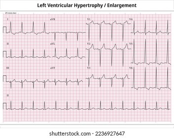 ECG Left Ventricular Enlargement - ECG Paper 12 Leads - Left Ventricular Hypertrophy svg