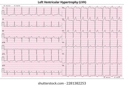 Hipertrofia Ventricular Izquierda ECG (LVH) - Ampliación Ventricular Izquierda - 12 Caso Común ECG Plomo - 6 Sec - Ilustración Vectorial