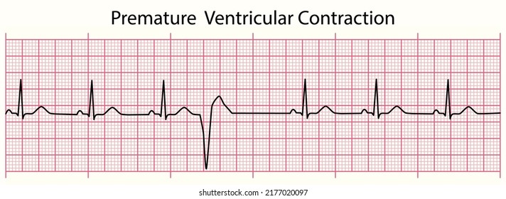 Línea ECG: Contracción ventricular prematura en 6 segundos de línea de papel ECG