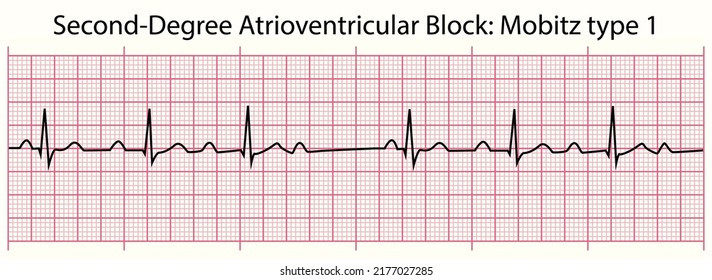 ECG Line: Second-Degree Atrioventricular Block: Mobitz Type 1 In 6 Second ECG Paper Line