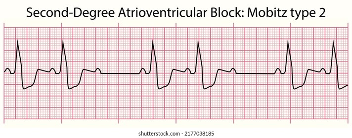 ECG Line: Second-Degree Atrioventricular Block: Mobitz Type 2 In 6 Second ECG Paper Line