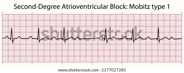 Ecg Line Seconddegree Atrioventricular Block Mobitz Stock Vector ...