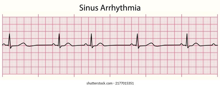 ECG line: Sinus Arrhythmia in 6 second ECG paper line