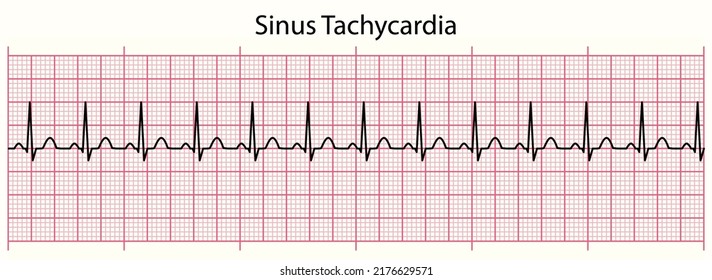 ECG line: Sinus Tachycardia in 6 second ECG paper line