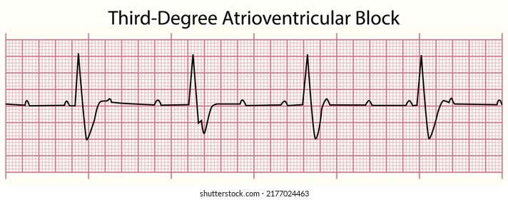 ECG line: Third-Degree Atrioventricular Block in 6 second ECG paper line