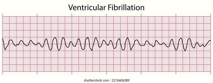 ECG Line: Ventricular Fibrillation In 6 Second ECG Paper Line