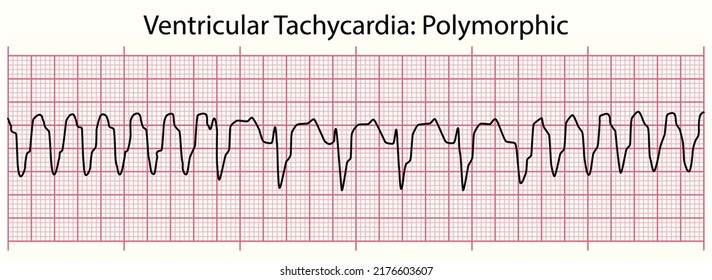 ECG line: Ventricular Tachycardia Polymorphic in 6 second ECG paper line