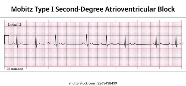 ECG Mobitz Type 1 Second Degree Atrioventricular Block - 2nd degree AV Block - 8 Second ECG Paper - Electrocardiography Vector Medical Illustration