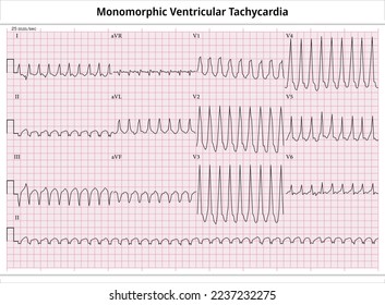 ECG Monomorphic VT - Ventricular Tachycardia - 12 Leads ECG Paper