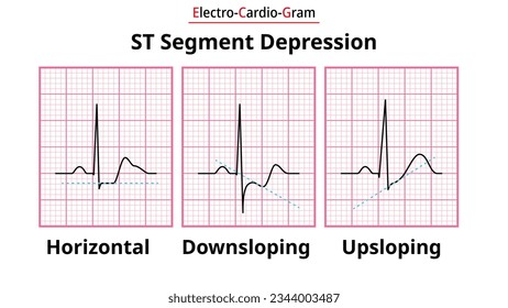 ECG Morphology of ST Segment Depression - Horizontal, Upsloping, and Downsloping - Medical Electrocardiogram Vector Illustration