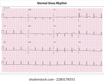 Ritmo de seno normal de ECG - 12 caso común de ECG de plomo - 3 secadora - Ilustración de vectores