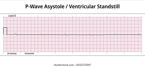 Onda P de ECG Asistolia - Parada ventricular - 8 segundos ECG papel - Electrocardiograma médico ilustración vectorial