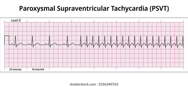 ECG Paroxysmal Supraventricular Tachycardia (PSVT) - 8 Second ECG Paper - Electrocardiogram Vector Medical Illustration