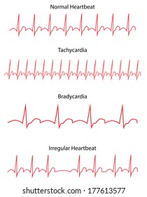 ECG Pathology Trace