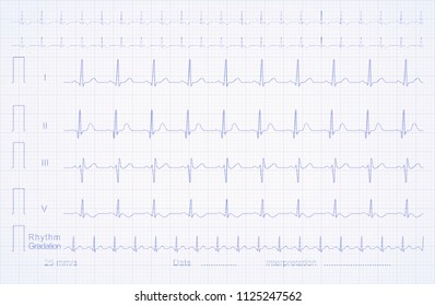 similar images stock photos vectors of ekg of normal heartbeat and