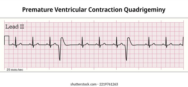 ECG Premature Ventricular Contraction Quadrigeminy - 8 Second ECG Paper