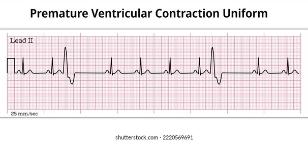 ECG Premature Ventricular Contraction Uniform - Unifocal - 8 Second ECG Paper - Ventricular Extrasystole