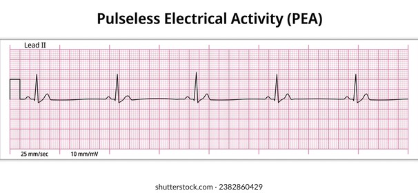 EKG Pulsellose elektrische Aktivität (PEA) - 8. ECG-Papier - Vektormedizinische Vektorgrafik des Elektrokardiogramms