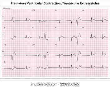 ECG PVC (Premature Ventricular Contractions) - ECG VES (Ventricular Extrasystoles) - 12 Leads ECG Paper