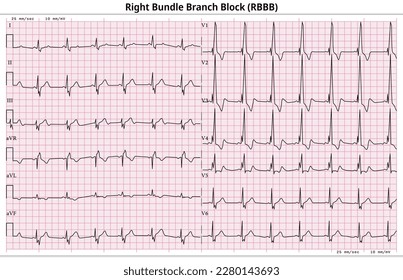 ECG RBBB (Right Bundle Branch Block) - 12 Lead ECG Common Case - 6 Sec - Vector Illustration