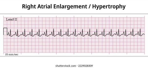 ECG Right Atrial Enlargement - 8 Second ECG Paper - Right Atrial Hypertrophy