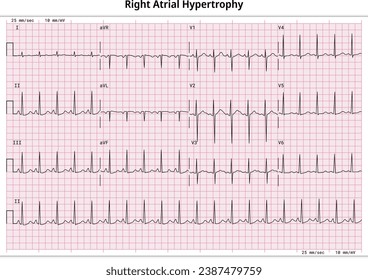 ECG Right Atrial Hypertrophy (RAH) - Right Atrial Enlargement (RAE) - 12 Lead ECG Common Case - 3 Sec per lead - Electrocardiogram Medical Vector Illustration