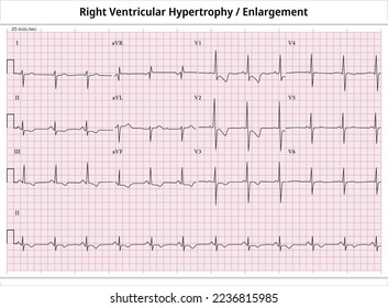 ECG Right Ventricular Enlargement - ECG Paper 12 Leads - Right Ventricular Hypertrophy