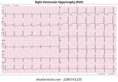 ECG Right Ventricular Hypertrophy (LVH) - Left Ventricular Enlargement - 12 Lead ECG Common Case - 6 Sec - Medical Vector Illustration