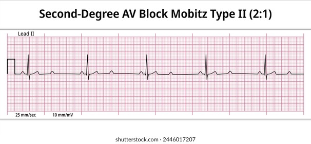 ECG Second Degree AV Block Mobitz Type 2 (2:1) - 8 Sec Electrocardiogram - Medical Vector Illustration