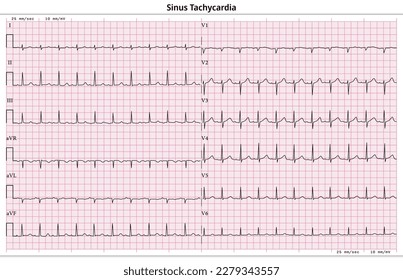 ECG Sinus Bradykardie - 12 Haupt-ECG-Fall - 6 Sec - Vektorgrafik