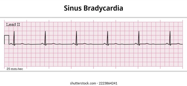 ECG Sinus Bradycardia - 8 Second ECG Paper 