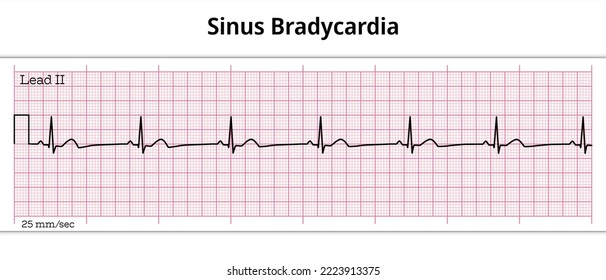 ECG Sinus Bradycardia - 8 Second ECG Paper 