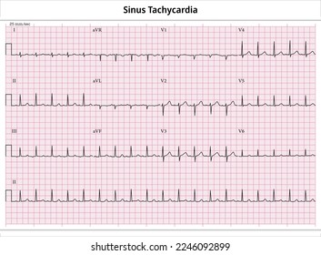 ECG Sinus Tachycardia - 12 Leads ECG Paper - Vector - Medical Illustration