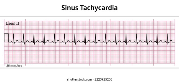 ECG Sinus Tachycardia - 8 Second ECG Paper - Electrocardiography Vector Medical Illustration