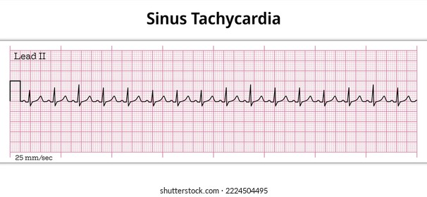 ECG Sinus Tachycardia - 8 Second ECG Paper 